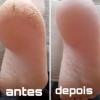 Plástica dos pés