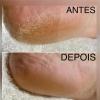 Plástica dos pés