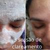 Clareamento facial 