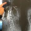 Aluna com várias cirurgias na coluna Vertebral.  Aluna com várias cirurgias na coluna Vertebral.