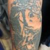 (Depois) Remoção de tatuagem
