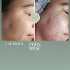 Regenera facial