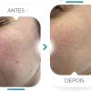 Regenera facial