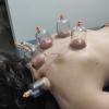 Ventosaterapia com Dry Needling 