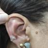 Auriculoterapia 