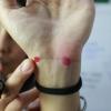 Acupuntura 