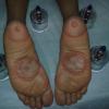 REFLEXOTERAPIA