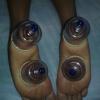 REFLEXOTERAPIA