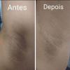 Clareamento de manchas