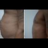 Redução de gordura abdominal
