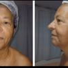 Rejuvenescimento facial
