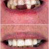 11• Antes e depois procedimento estético