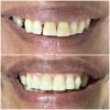 9• Antes e depois procedimento estético