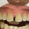 3• Antes: fechamento de diastema