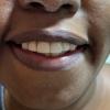 17• Depois:facetas