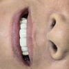 12• Depois: facetas