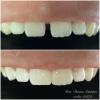 4• Antes e depois, fechamento de diastema