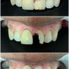 8• Antes e depois: faceta