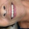 13• Depois: facetas
