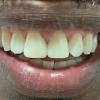 3• Depois: fechamento de diastema