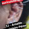 Auriculoterapia