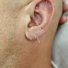 Auriculoterapia 