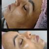 Revitalização Facial