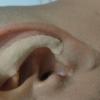 Bandagem Auricular Magnética analgesia eficaz