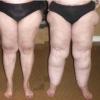 Tratamento de lipedema