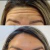 Botox na região da testa