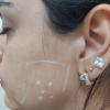Botox para bruxismo
