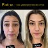 Botox 3 regiões