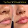 Preenchimento labial