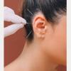 Auriculoterapia
