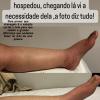 Drenagem em lipedema