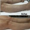 Drenagem em lipedema