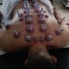 Ventosaterapia para alivio  de dores