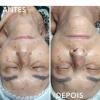 Antes e depois limpeza de pele