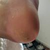 Ressecamento plantar