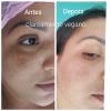 Clareamento de melasma