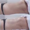 3 sessão de massagem modeladora