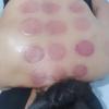 Ventosaterapia