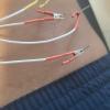 Dry needling com eletroterapia