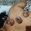 Ventosaterapia