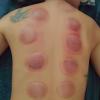Massagem desportiva com ventosas