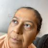 Correção de Melasma