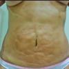 Tratamento de Quelóides, Nódulos, Fibrose