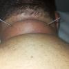 Acupuntura
