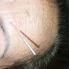 Acupuntura Estética