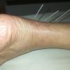 Acupuntura